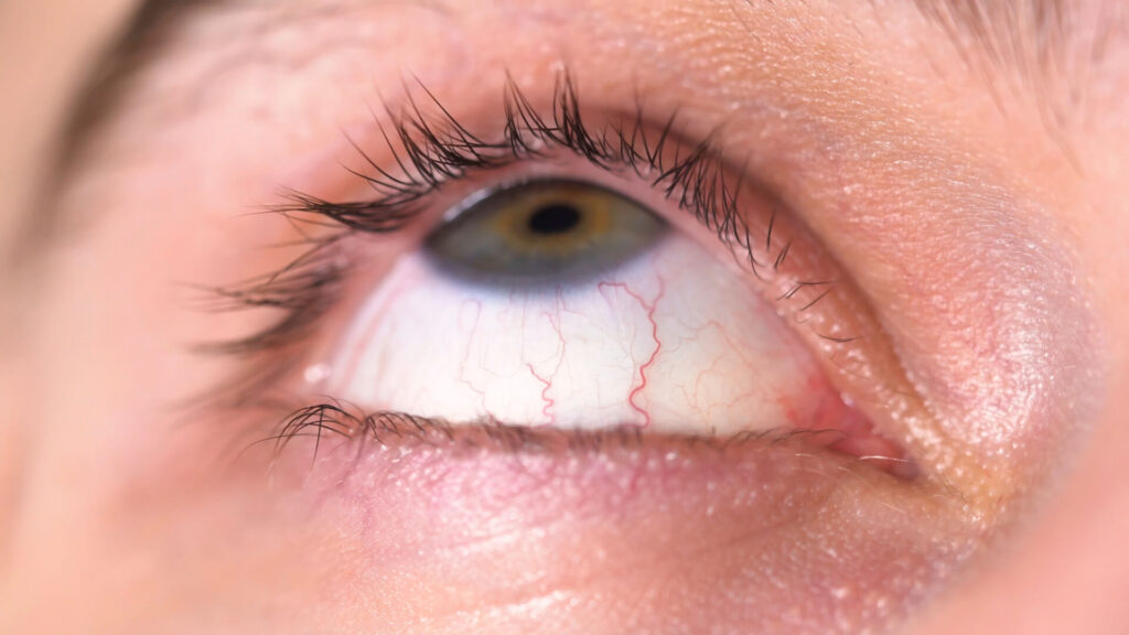 თვალების სიმშრალე და შფოთვითი ფიქრები შეიძლება ბევრად უფრო მჭიდროდ იყოს დაკავშირებული, ვიდრე გვგონია.