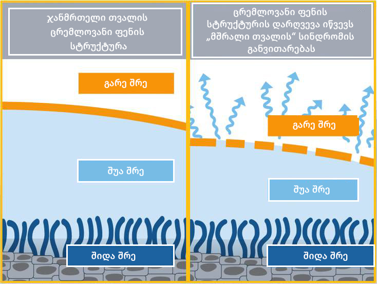 Симптомы синдрома «сухого глаза»